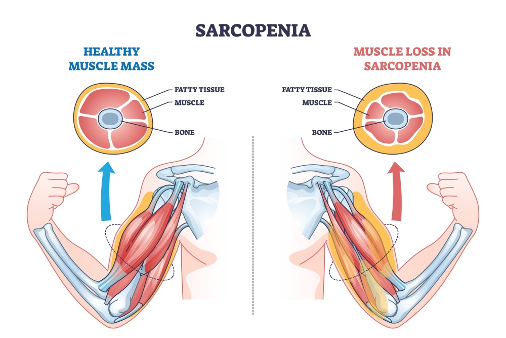 vector image of muscle with sarcopenia