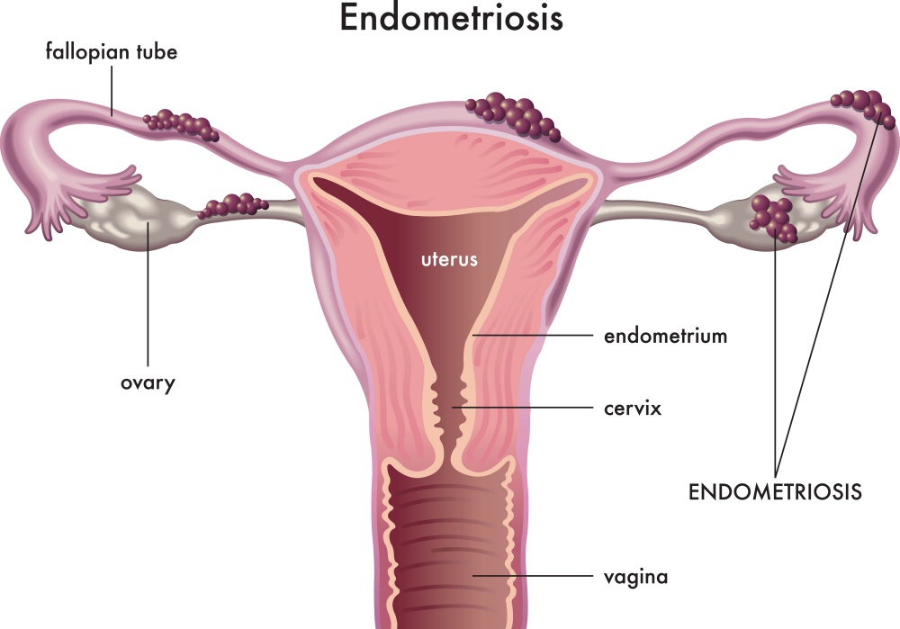 vector image of endometriosis